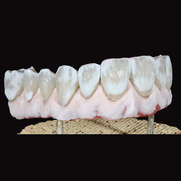 La cocción de corrección con PEARL shell en la zona de los dientes y con GINGIVA light-rose en la zona gingival.