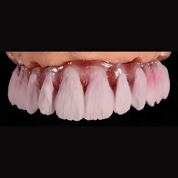 El núcleo de dentina con DENTINE A3 en los caninos y con DENTINE A2 en los demás dientes.