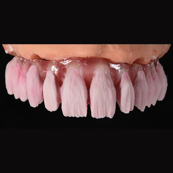 Tras la estratificación del núcleo de dentina, se realizaron cut backs anatómicos.