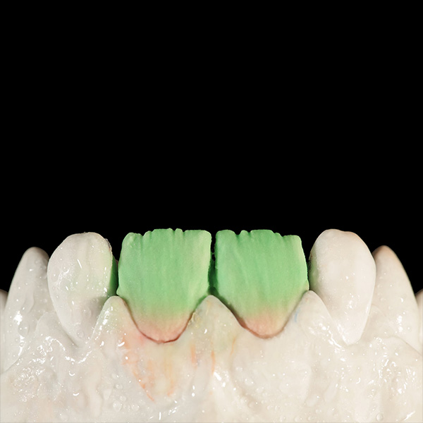 Dans les autres deux tiers, le noyau de dentine a été réalisé avec DENTINE A1 plus claire.