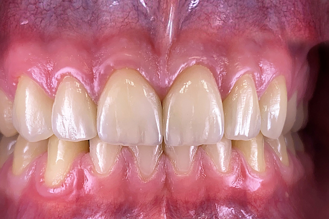Final treatment result after full-adhesive cementation of the highly esthetic veneers.