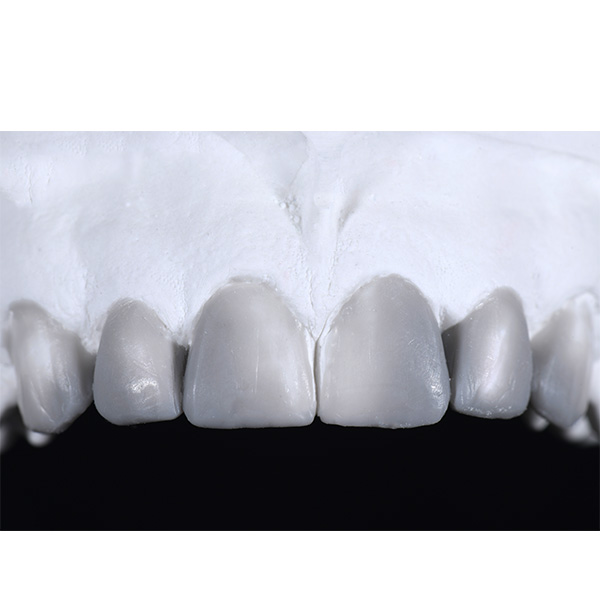En el modelo diagnóstico del maxilar superior se llevó a cabo un encerado con morfología estética ideal.