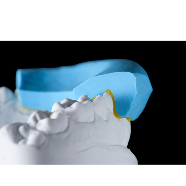 Se tomó una impresión parcial de silicona para crear un mock-up en la boca del paciente.