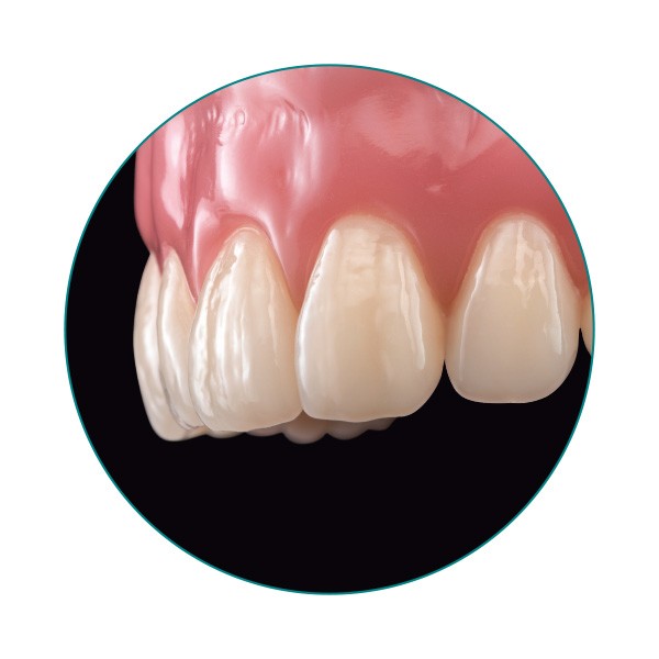 Der VITA VIONIC VIGO Zahn in der Prothese