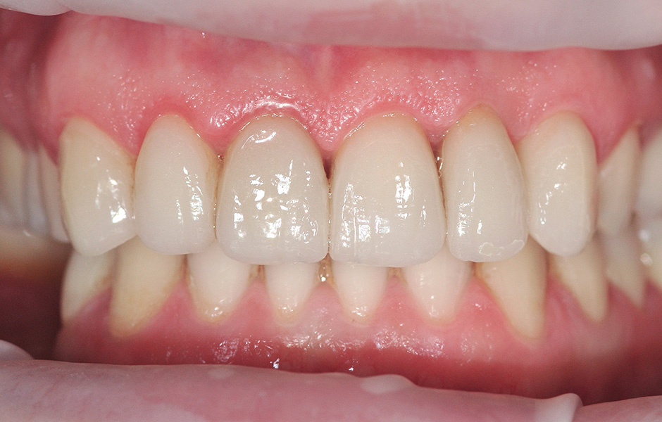 El protésico dental Okke Kamps fijando dientes VITA VIONIC VIGO en una base de prótesis fresada digitalmente.