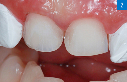 La preparación mínimamente invasiva en los dientes 11 y 21, antes de la colocación de las carillas.