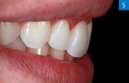 Vista lateral de la arcada dentaria armonizada.