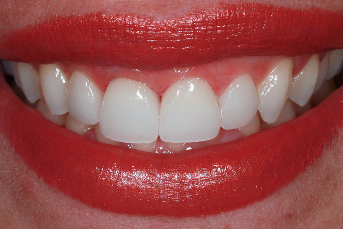 El resultado altamente estético de la restauración monolítica con carillas desde el diente 12 hasta el 22.