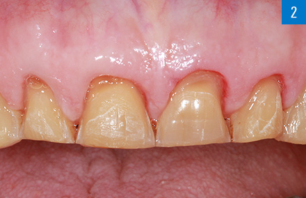 Situación en el maxilar superior tras la preparación guiada del mock-up.
