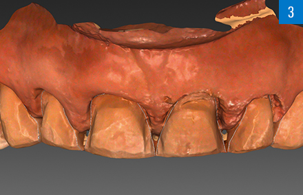 Las preparaciones escaneadas del maxilar superior en el software CAD.