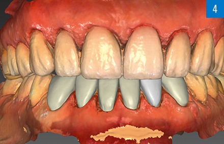 Las carillas diseñadas en los maxilares superior e inferior en el software CAD.