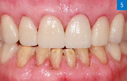 Las carillas de VITABLOCS TriLuxe forte tras la colocación en el maxilar superior.