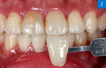 El color dental 2M1 determinado digitalmente se documentó con la varilla de color correspondiente.