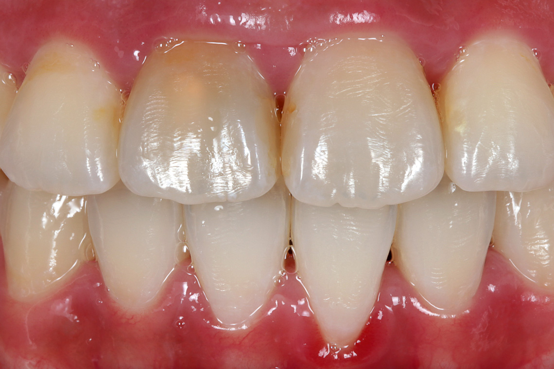 Situación de partida: El diente 11 estaba fuertemente decolorado tras una endodoncia.