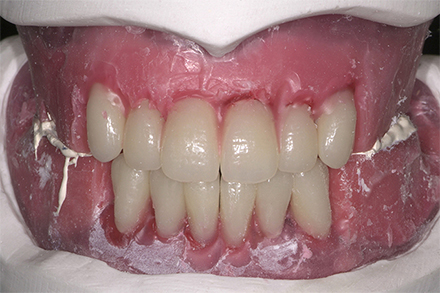 Aufstellung der Zähne 32 und 42 in die entstandene Lücke.