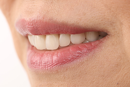 Attuazione estetica e funzionale con denti anteriori VITAPAN® e denti posteriori VITA LINGOFORM®.