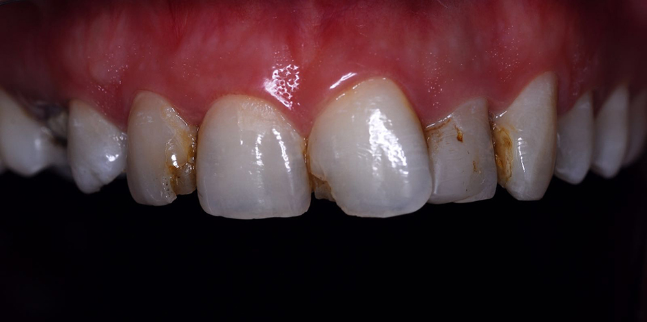 Halit Yagci. Anterior crowns, Anterior tooth veneers, Implant treatment