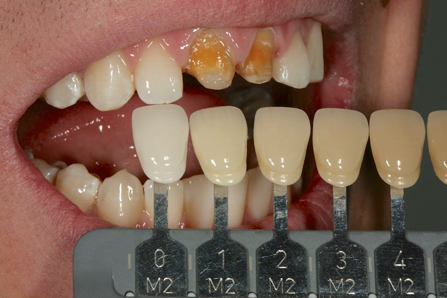 А3 цвет зубов фото у женщин