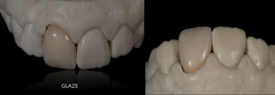 Клинический случай: Единичная коронка на передний зуб из VITAPM®9. Francesco Ferretti. Rom, Italien.