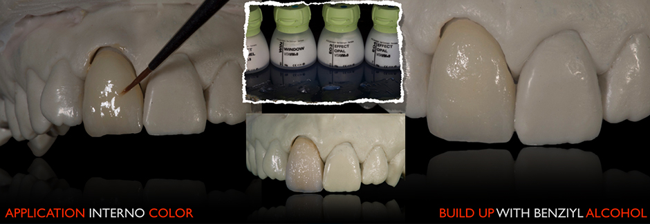 Клинический случай: Единичная коронка на передний зуб из VITAPM®9. Francesco Ferretti. Rom, Italien.