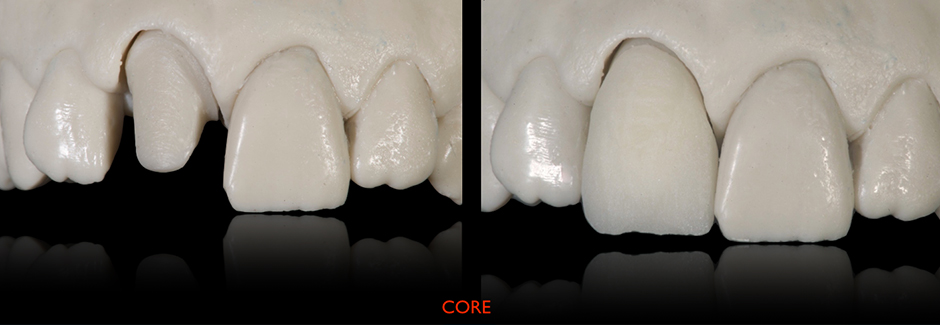 Клинический случай: Единичная коронка на передний зуб из VITAPM®9